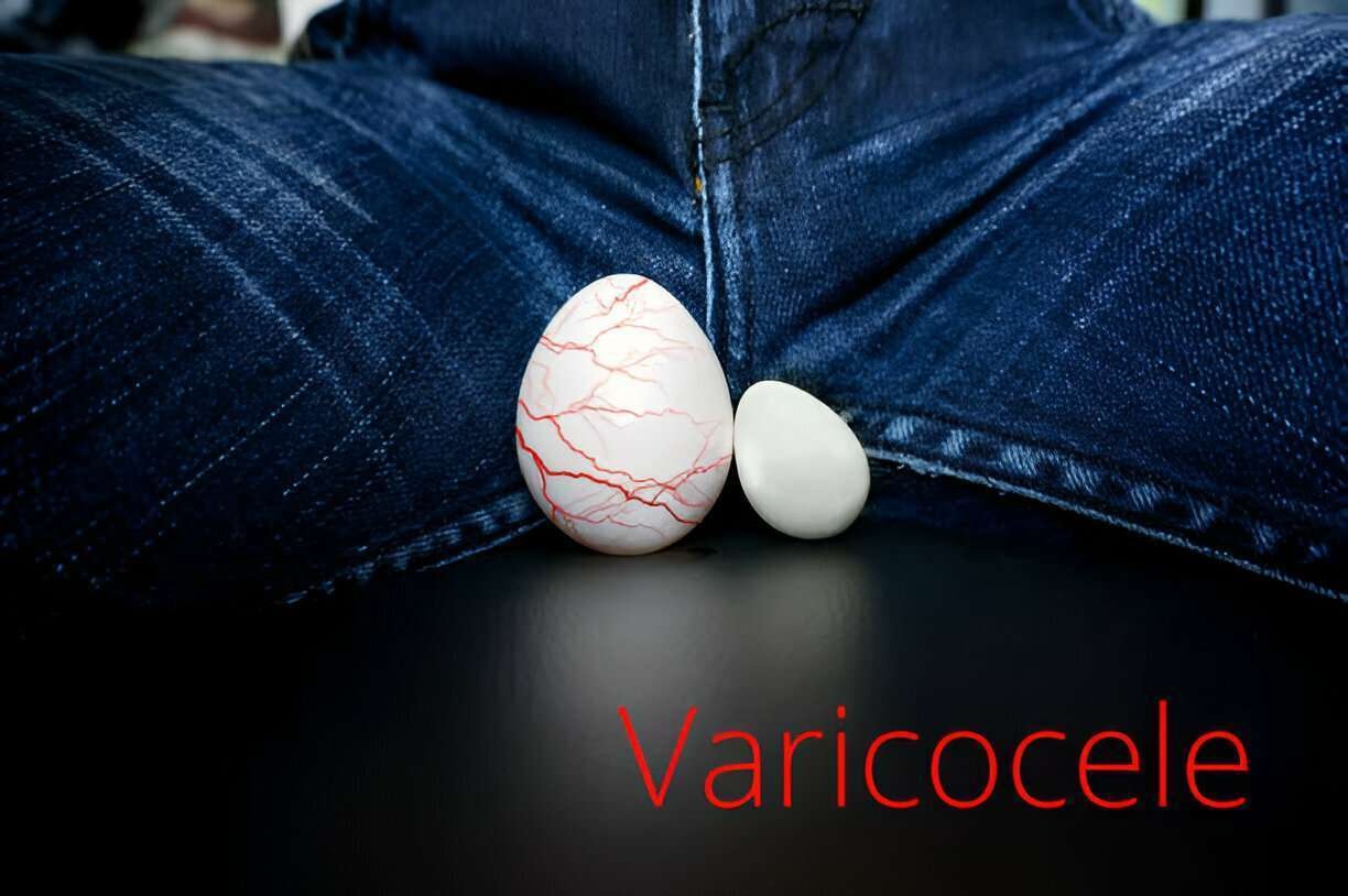 Varicocele Grades & Holistic Solutions